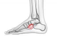 What Does Cuboid Syndrome Feel Like?